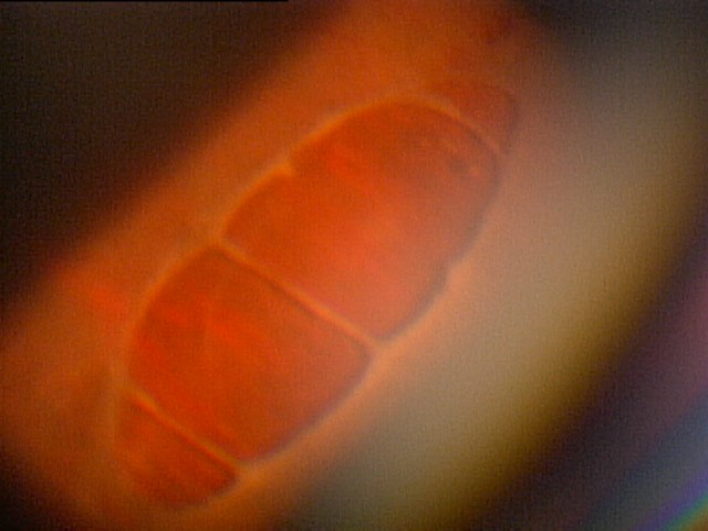 網膜剥離のイメージ(図-1)