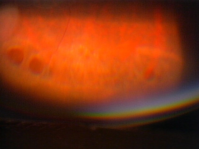網膜剥離のイメージ(図-2)