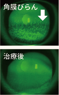 角膜びらんと治療後